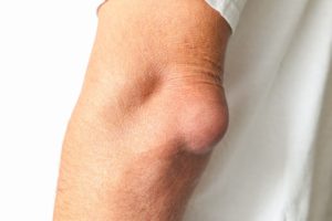 Bursitis de codo qué es causa síntomas y tratamiento PUVA