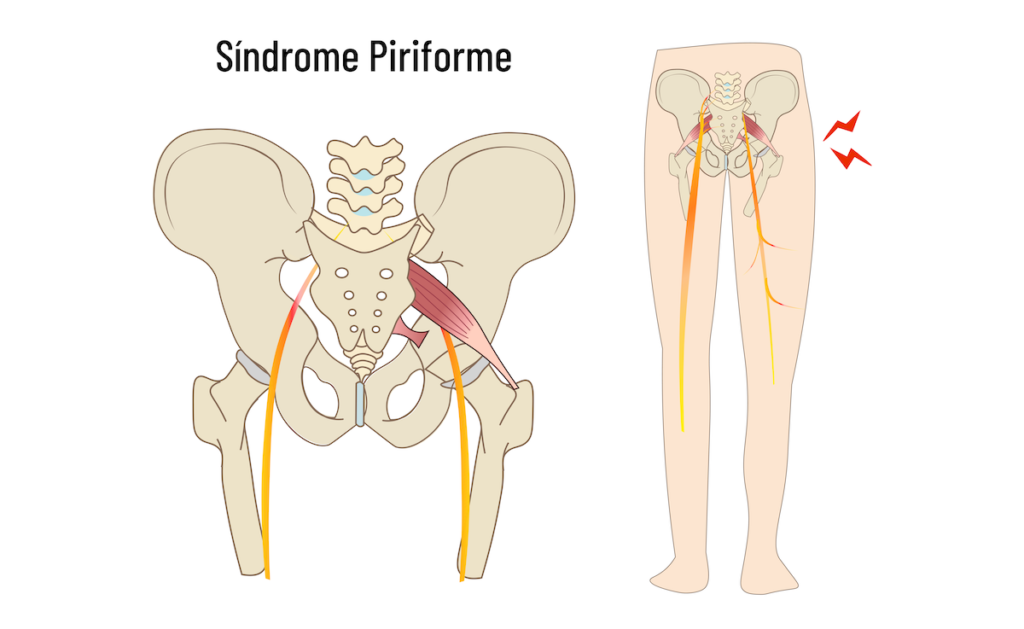 síndrome piriforme